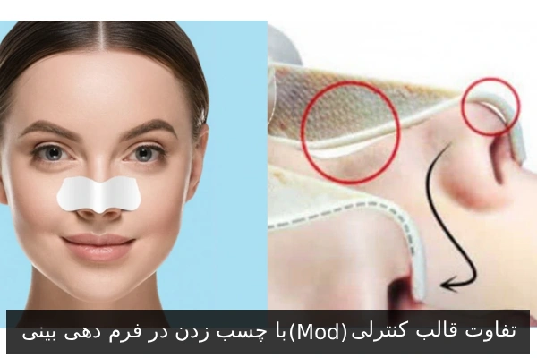 تفاوت قالب کنترلی (Mod) با چسب زدن در فرم دهی بینی