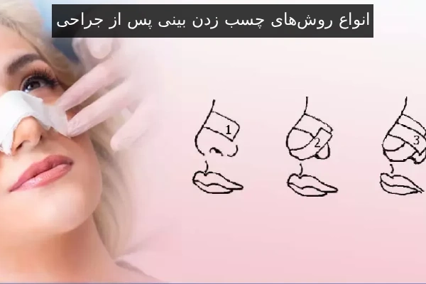 انواع روش‌های چسب زدن بینی پس از جراحی