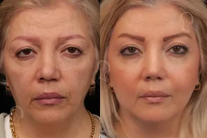 لیفت شقیقه