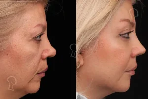 لیفت شقیقه