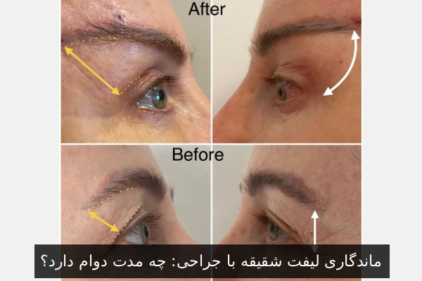 ماندگاری لیفت شقیقه با جراحی: چه مدت دوام دارد؟