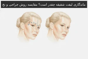 ماندگاری لیفت شقیقه چقدر است؟ مقایسه روش جراحی و نخ