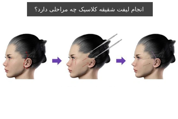 انجام لیفت شقیقه کلاسیک چه مراحلی دارد؟