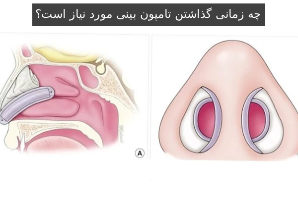 چه زمانی گذاشتن تامپون بینی مورد نیاز است؟
