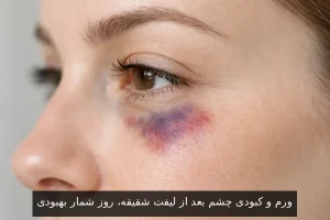 ورم و کبودی چشم بعد از لیفت شقیقه، روز شمار بهبودی