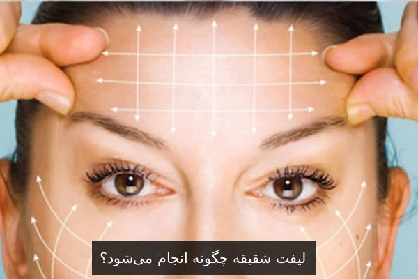 لیفت شقیقه چگونه انجام می‌شود؟