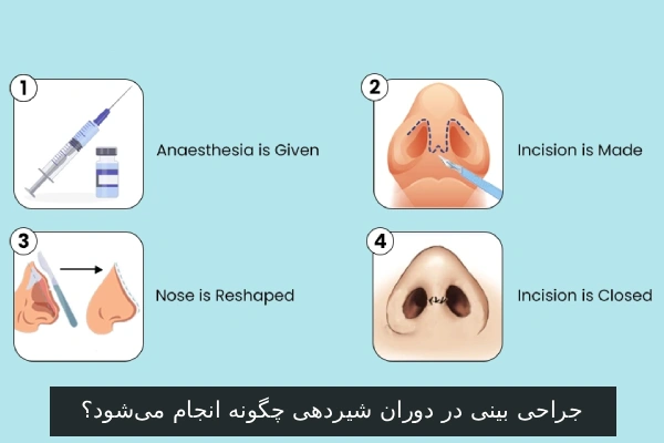 جراحی بینی در دوران شیردهی چگونه انجام می‌شود؟