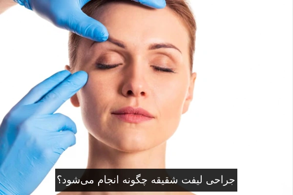 جراحی لیفت شقیقه چگونه انجام میشود؟