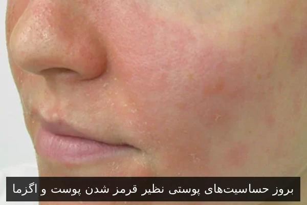 بروز حساسیتهای پوستی نظیر قرمز شدن پوست و اگزما