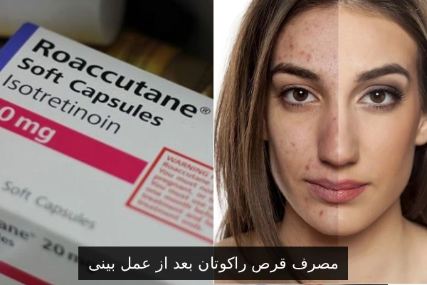 مصرف قرص راکوتان بعد از عمل بینی