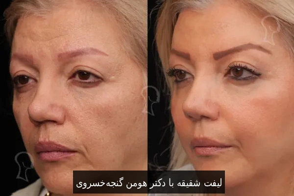 لیفت شقیقه با دکتر هومن گنجهخسروی
