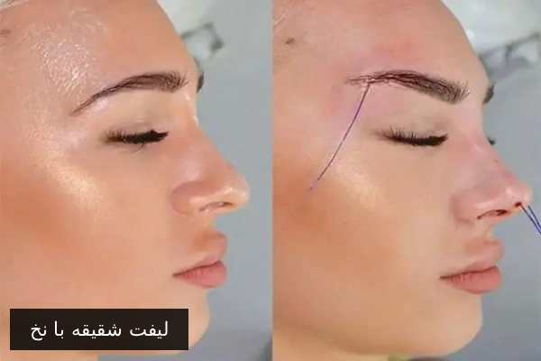 لیفت شقیقه با نخ
