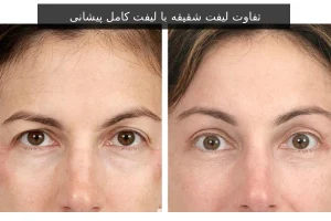 تفاوت لیفت شقیقه ((Temporal با لیفت کامل پیشانی (Forehead)