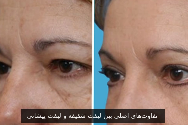 تفاوت‌های اصلی بین لیفت شقیقه و لیفت پیشانی